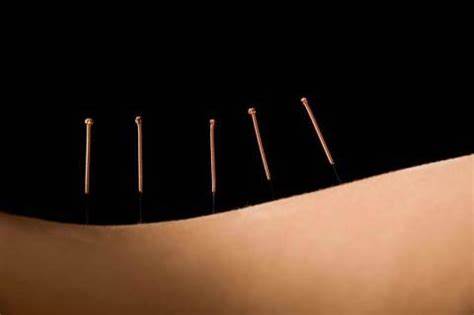 ACUPUNTURA